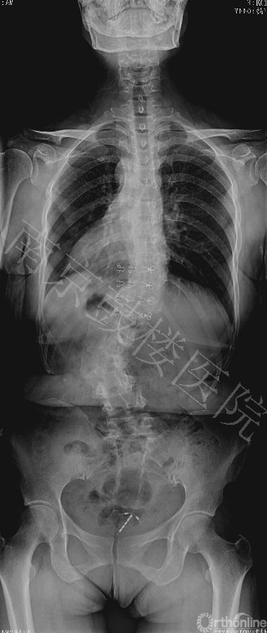 13812 术前 PA X ray.jpg