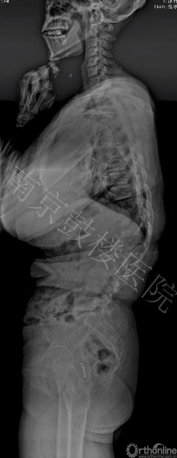 13812 术前 Lat X ray.jpg