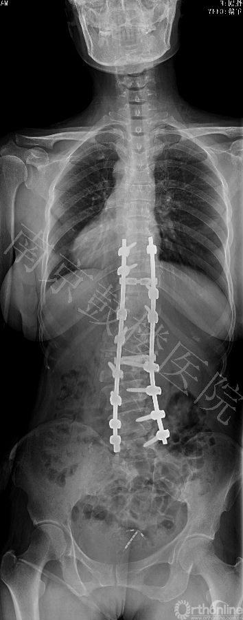 13812 术后 PA X ray.jpg