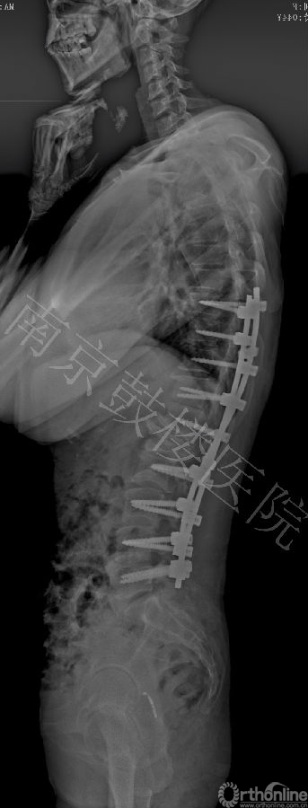 13812 术后 Lat X ray.jpg