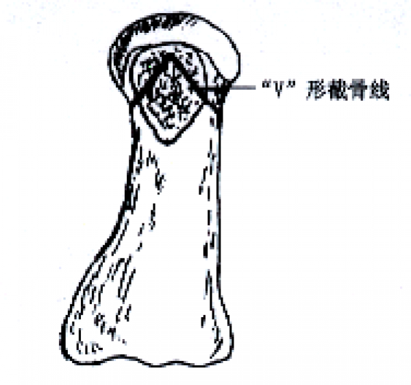 b 矢状面V形截骨.png