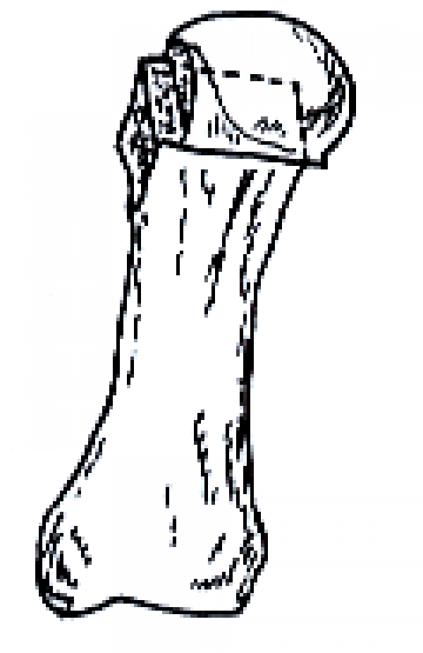 c 向外推移3~4 mm.png