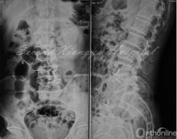 21术后X线_副本.jpg