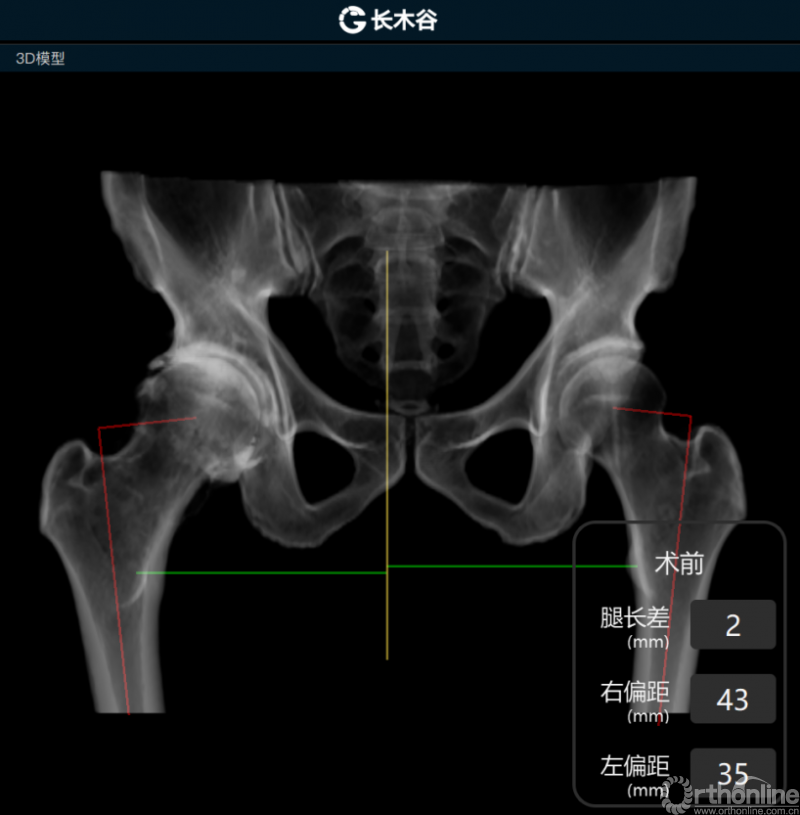 04-AI HIP系统对患者术前偏距与腿长差进行智能测量与评估.png
