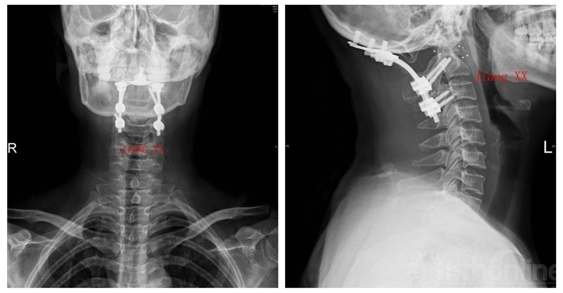 术后X线.jpg