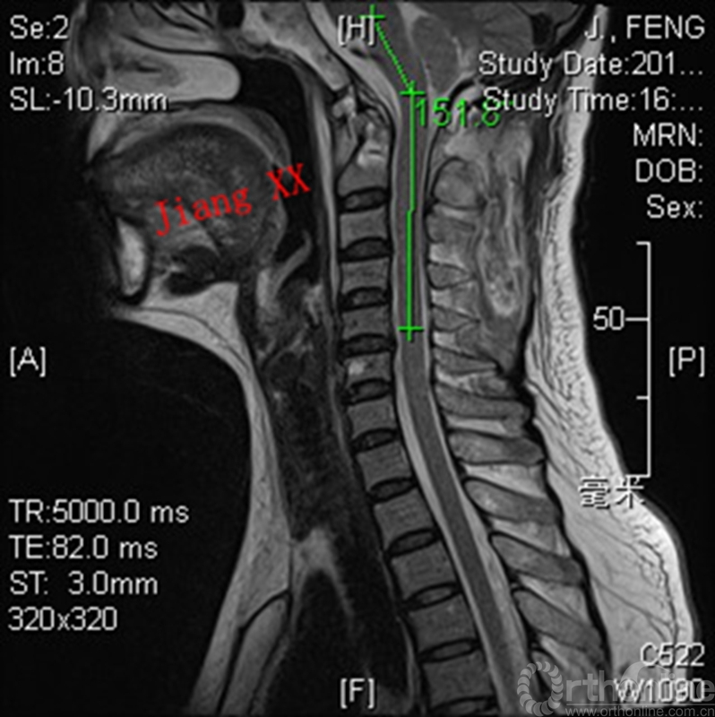 术后MRI.jpg
