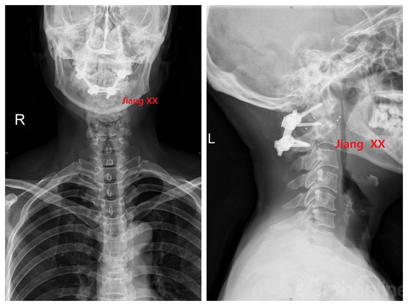 术后X线.jpg