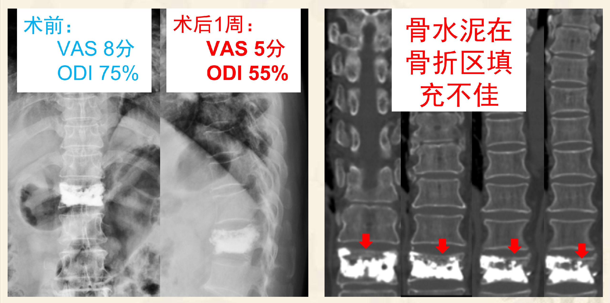 靶向锚定式椎体成形术  完整版(1)_3.png