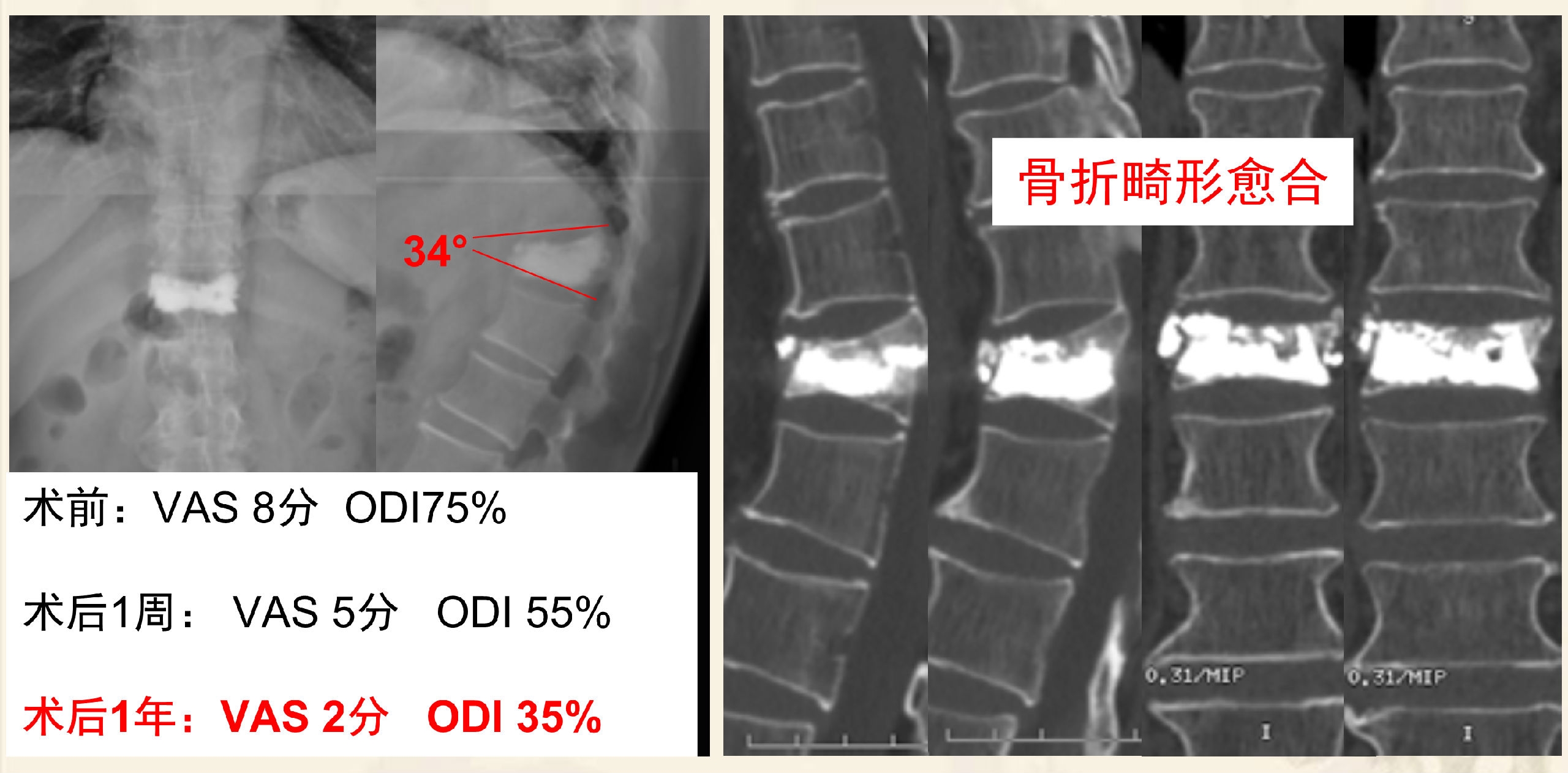 靶向锚定式椎体成形术  完整版(1)_4.png