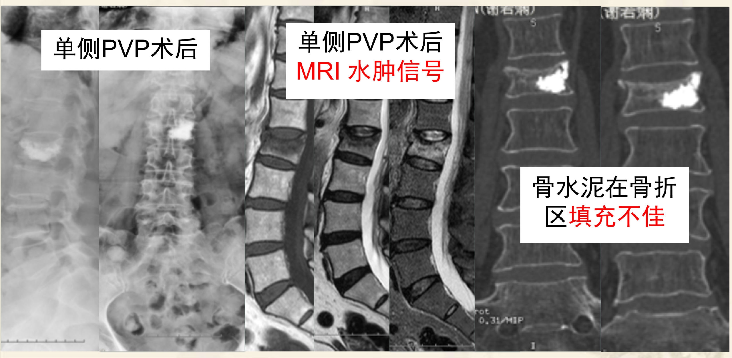 靶向锚定式椎体成形术  完整版(1)_5.png