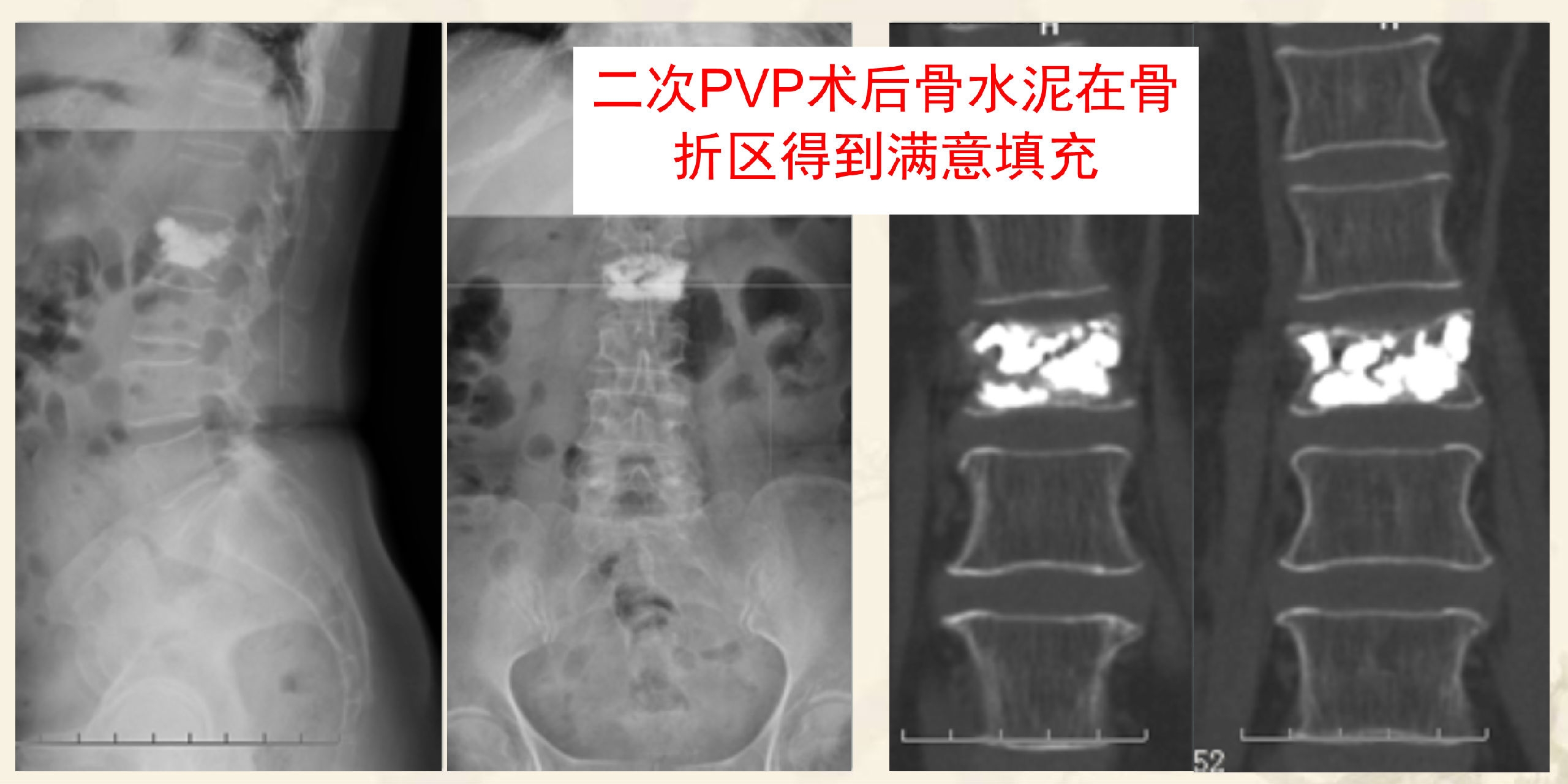 靶向锚定式椎体成形术  完整版(1)_6.png