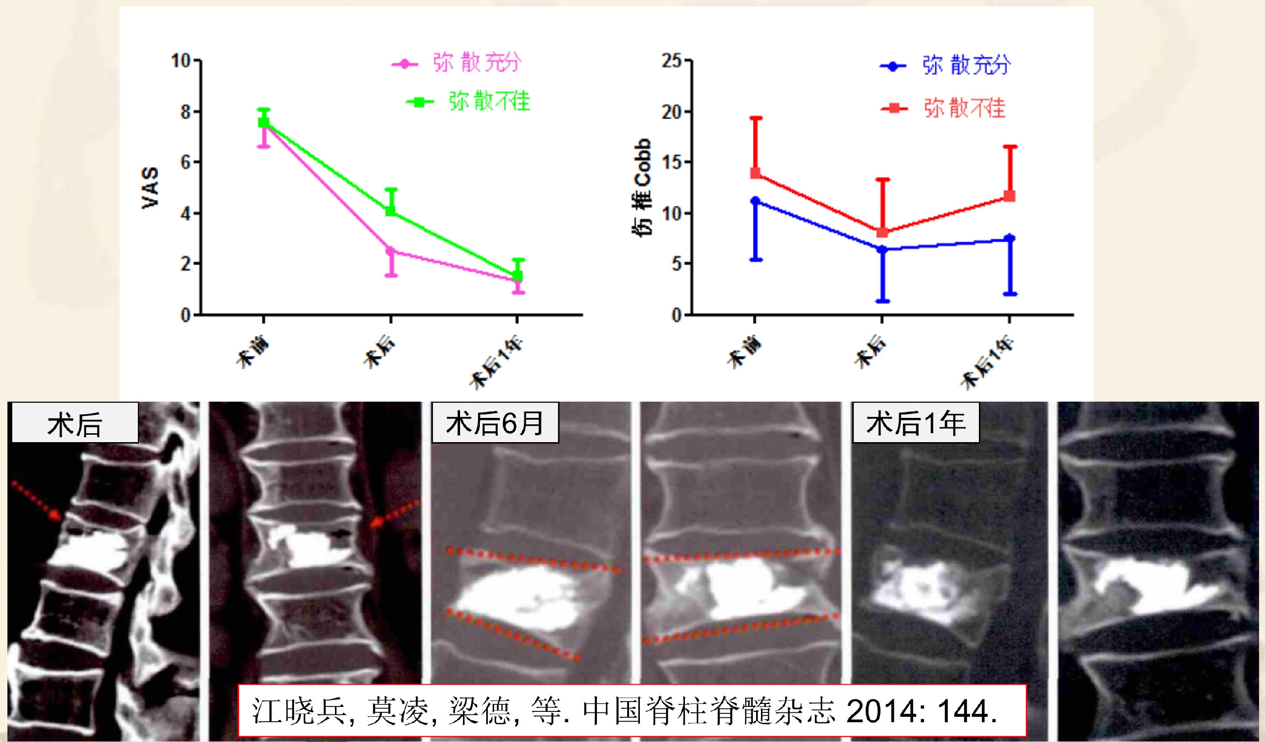 靶向锚定式椎体成形术  完整版(1)_8.png
