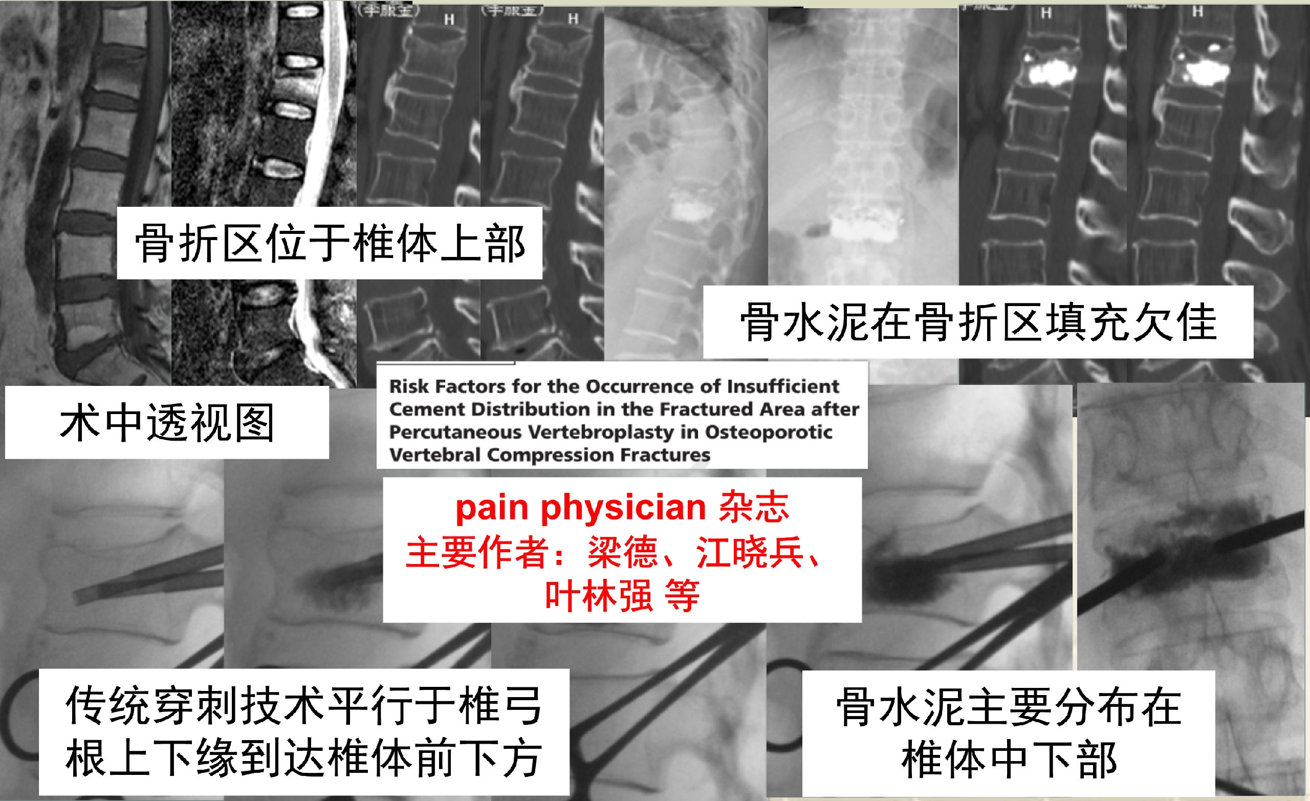 靶向锚定式椎体成形术  完整版(1)_14.png