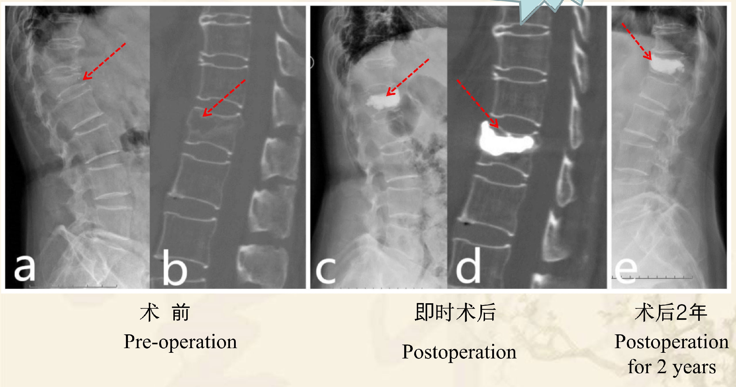 靶向锚定式椎体成形术  完整版(1)_17.png