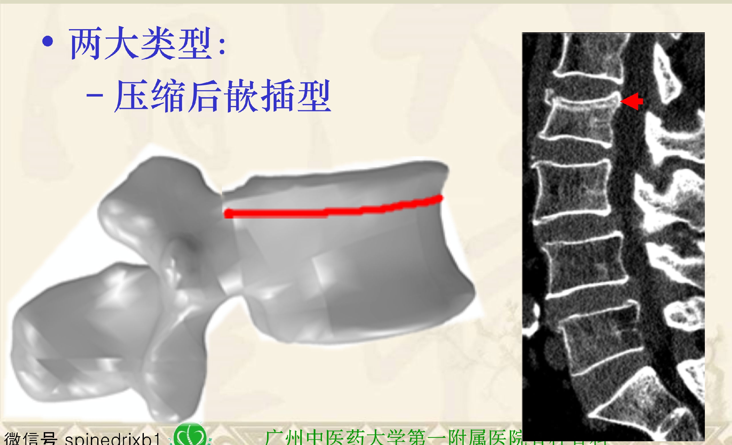 靶向锚定式椎体成形术  完整版(1)_20.png