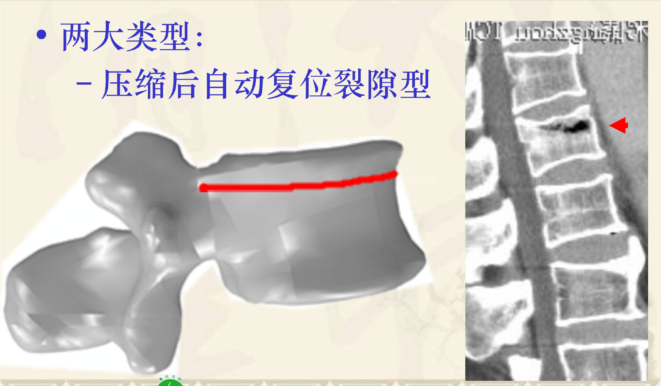 靶向锚定式椎体成形术  完整版(1)_21.png