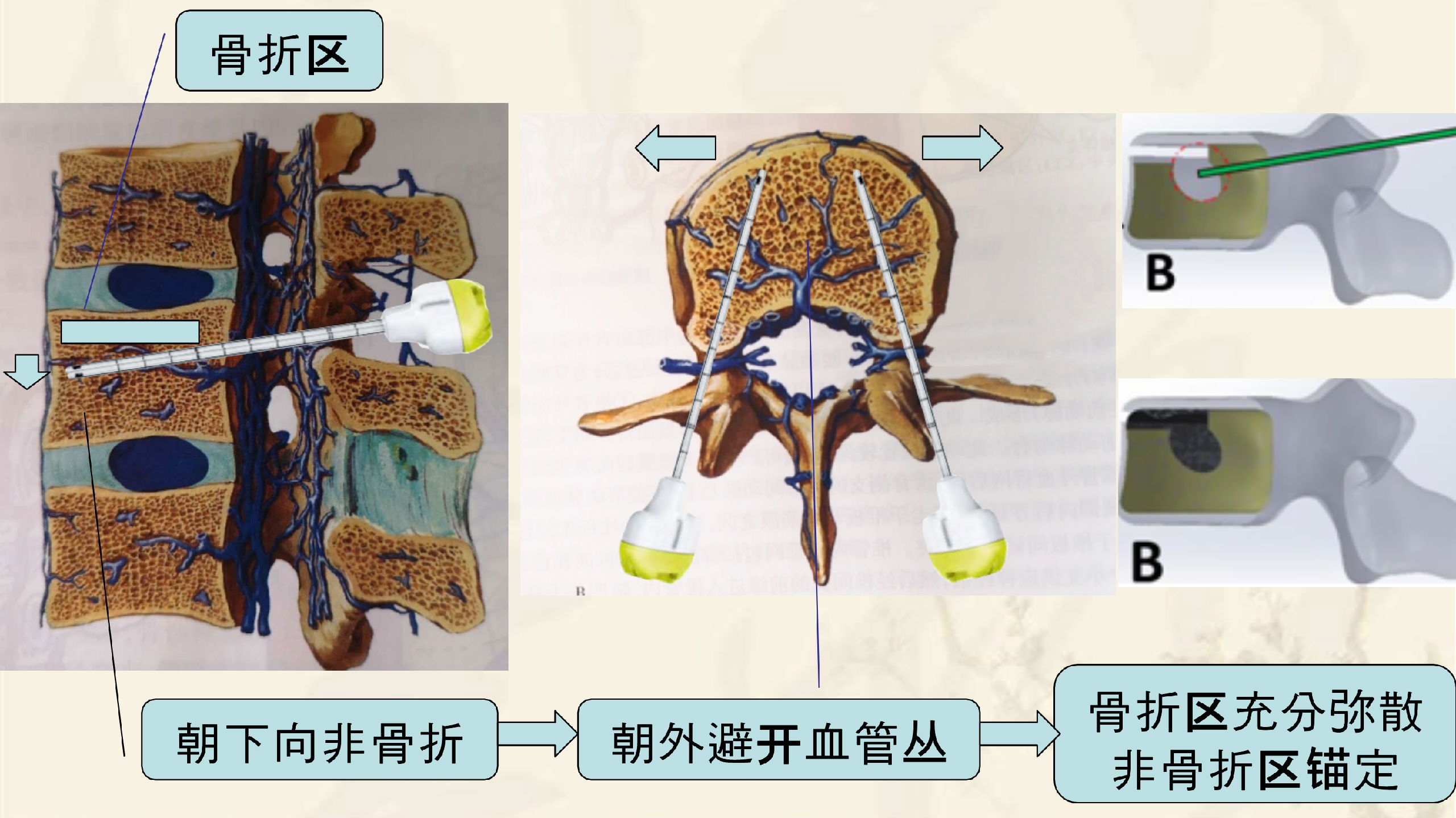 靶向锚定式椎体成形术  完整版(1)_27.png