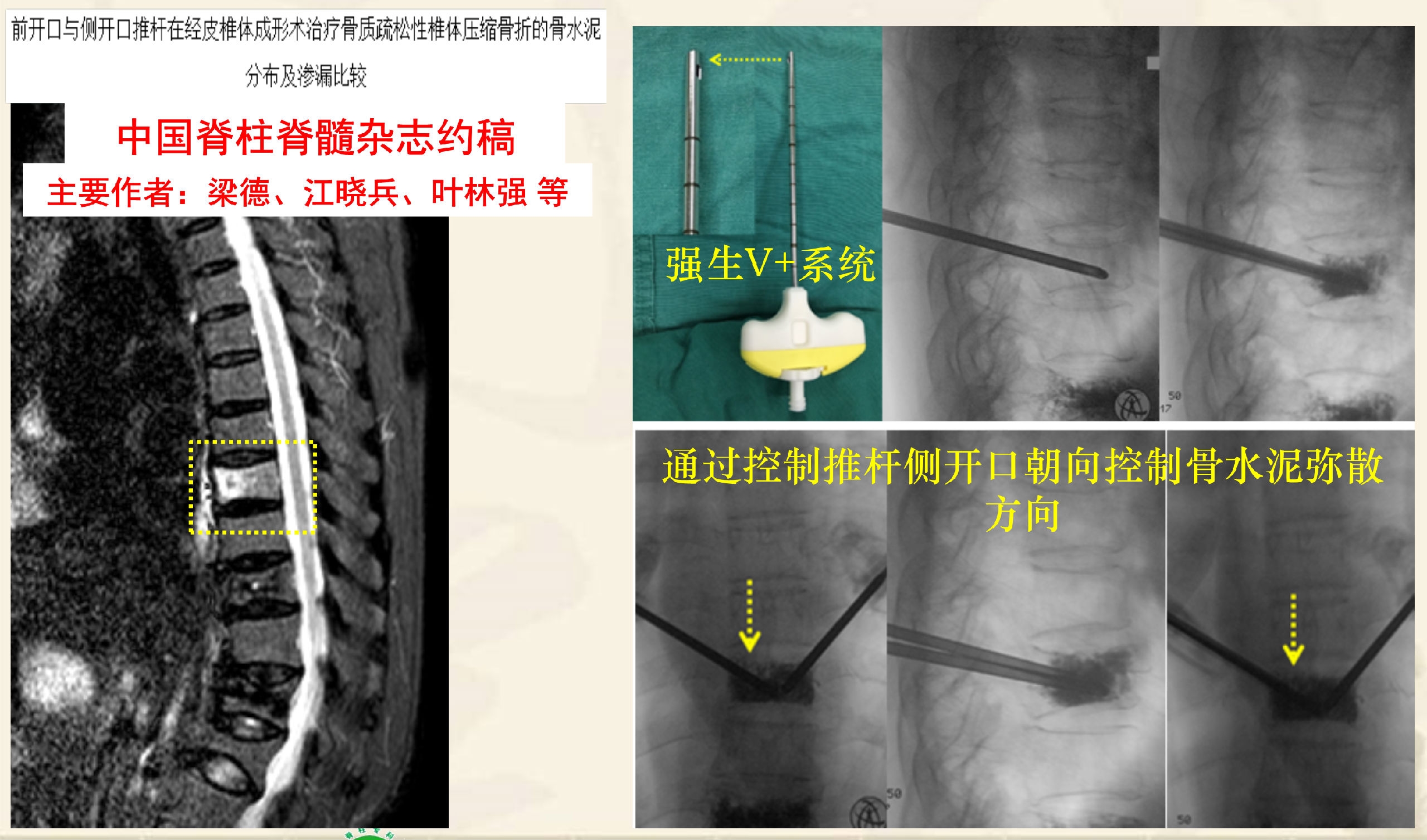 靶向锚定式椎体成形术  完整版(1)_44.png