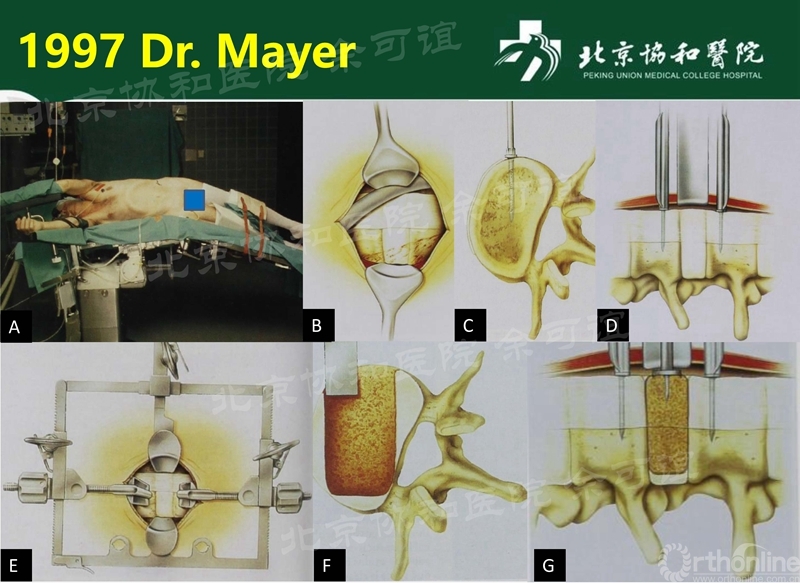 OLIF手术演化时间线_页面_1_副本.jpg
