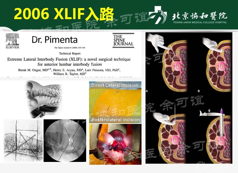 OLIF手术演化时间线_页面_2_副本.jpg