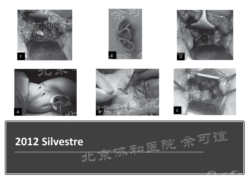 OLIF手术演化时间线_页面_3_副本.jpg