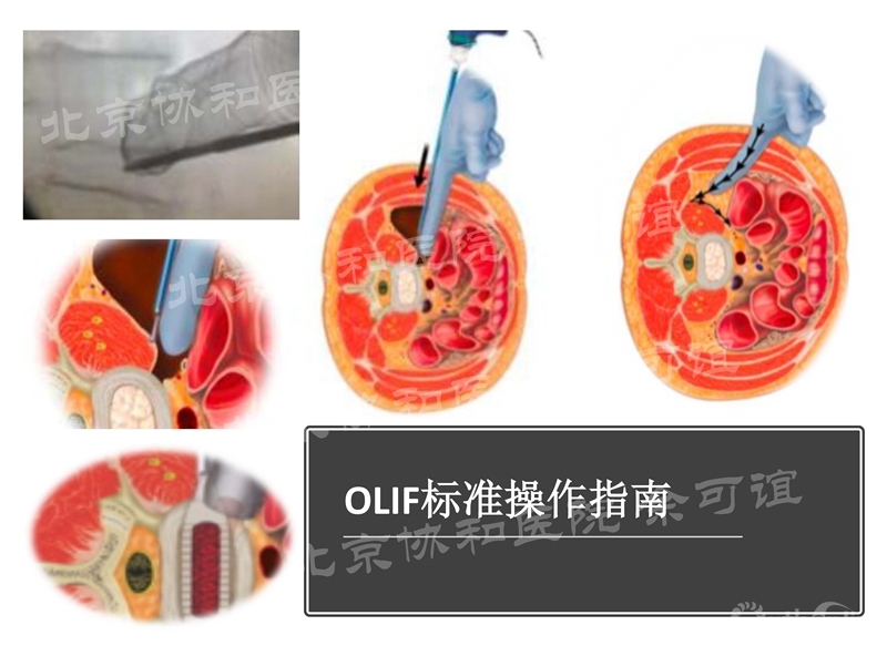 OLIF手术演化时间线_页面_4_副本.jpg