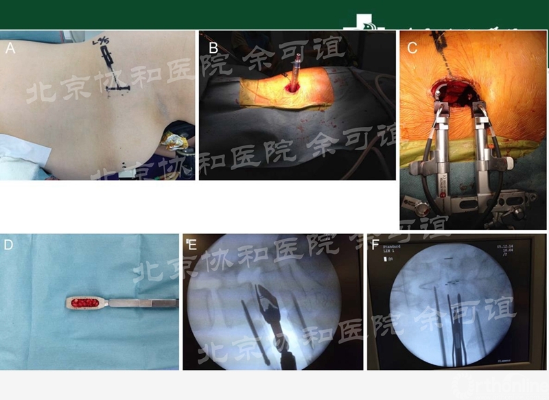 OLIF手术演化时间线_页面_5_副本.jpg