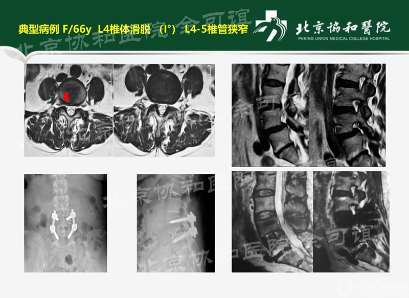 OLIF手术演化时间线_页面_7_副本.jpg