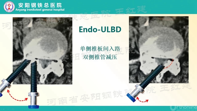 Endo--ULBD技术治疗腰椎管狭窄症的价值和边界(2)_副本.jpg