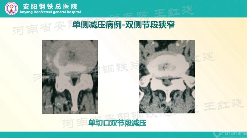 Endo--ULBD技术治疗腰椎管狭窄症的价值和1边界(2)_副本.jpg