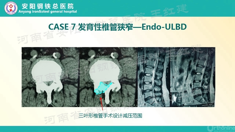 Endo--ULBD技术治疗腰椎管狭窄症的价值和边界(第二部分)_副本.jpg