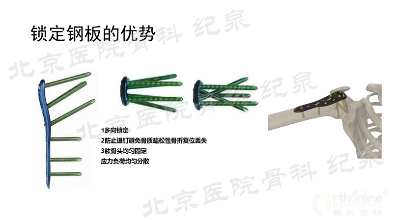 肱骨近端骨折微创OR传统中文版_页面_13_副本.jpg