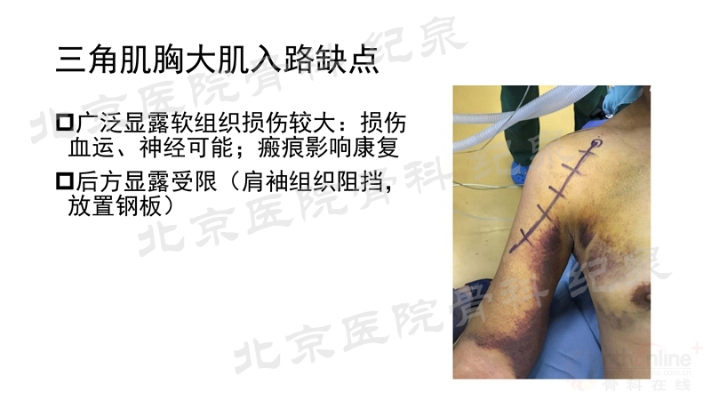 肱骨近端骨折微创OR传统中文版_页面_18_副本.jpg