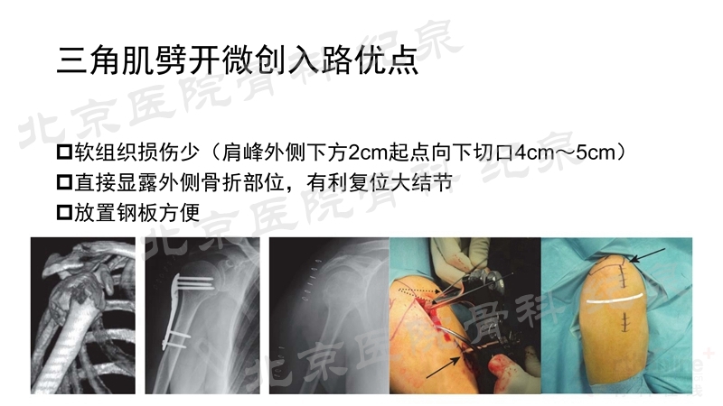 肱骨近端骨折微创OR传统中文版_页面_22_副本.jpg