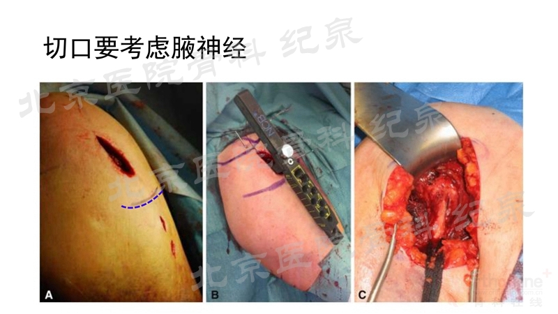 肱骨近端骨折微创OR传统中文版_页面_25_副本.jpg