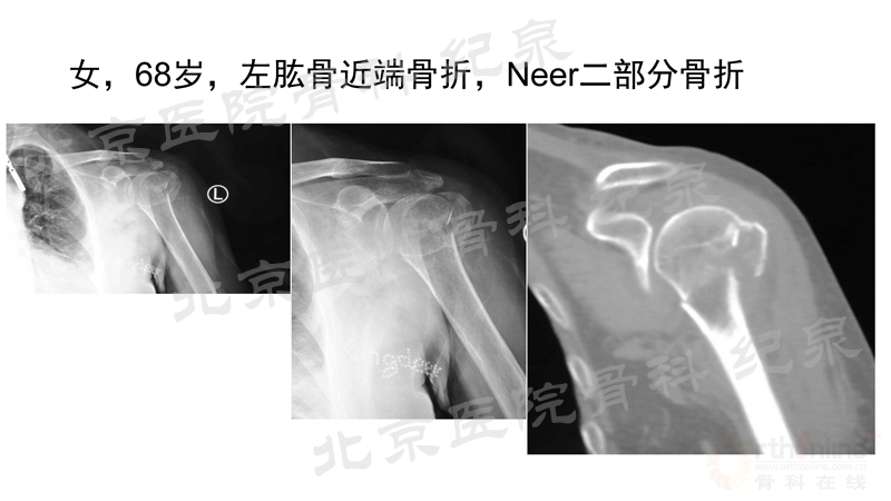 肱骨近端骨折微创OR传统中文版_页面_26_副本.jpg