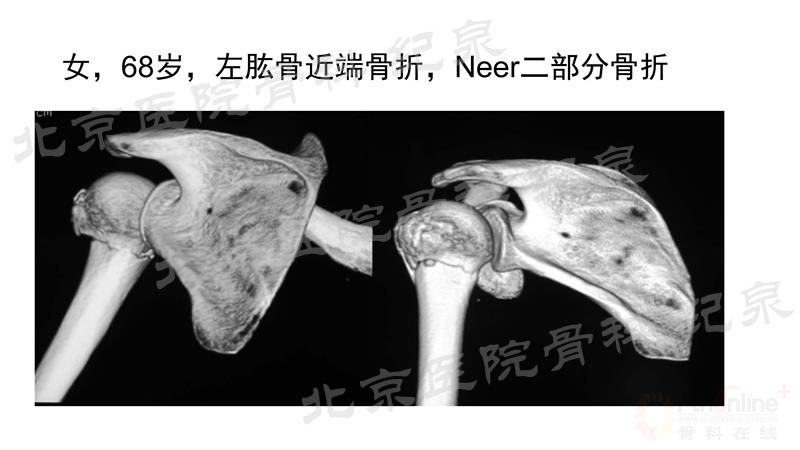 肱骨近端骨折微创OR传统中文版_页面_27_副本.jpg