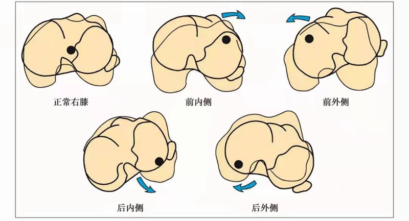 关节不稳图1.jpg