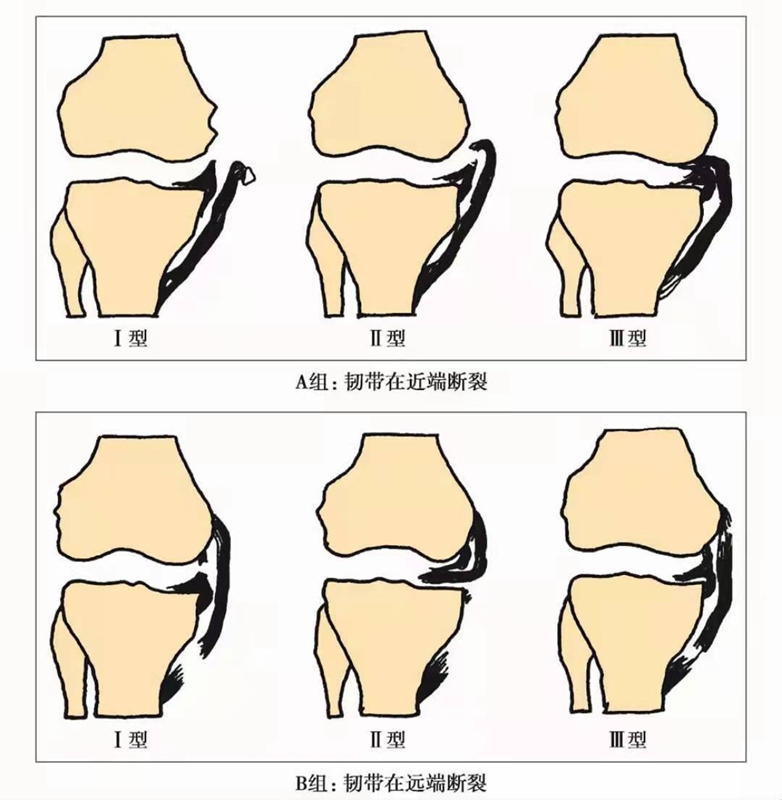 关节不稳图2.jpg